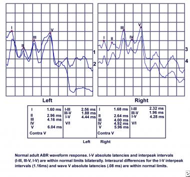 Auditory Brainstem Response (ABR)